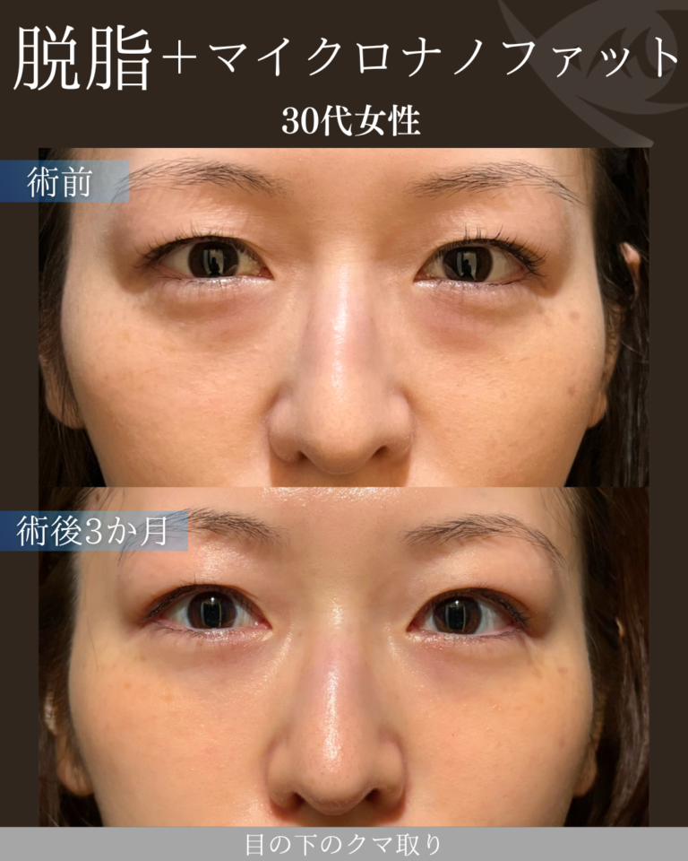 30代女性 脱脂＋マイクロナノファット 術後3ヶ月